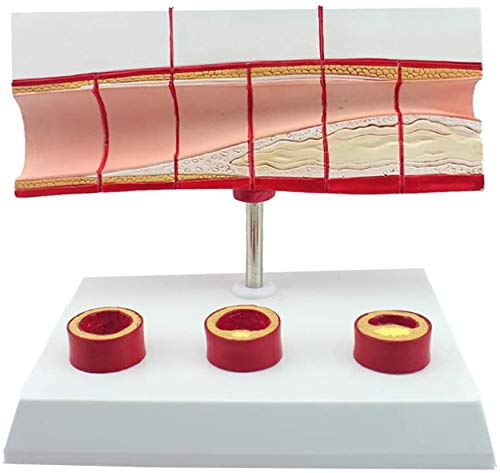 LBYLYH Trombosis Modelo De Proceso - Equipos Médicos CHD -PVC Corazón Humano Modelo Anatómico Modelo De Educación Médica para La Educación Médica