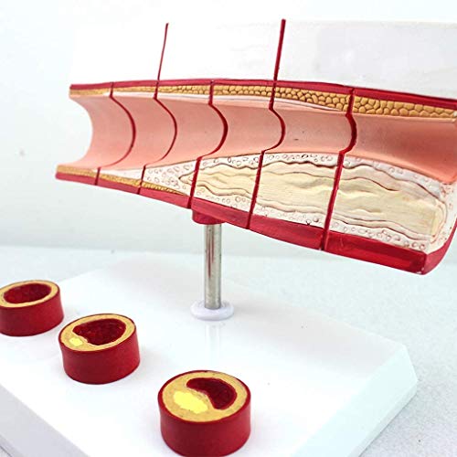 LBYLYH Trombosis Modelo De Proceso - Equipos Médicos CHD -PVC Corazón Humano Modelo Anatómico Modelo De Educación Médica para La Educación Médica