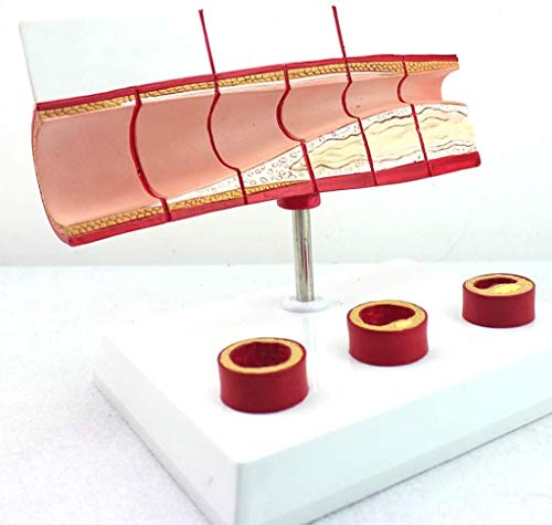 LBYLYH Trombosis Modelo De Proceso - Equipos Médicos CHD -PVC Corazón Humano Modelo Anatómico Modelo De Educación Médica para La Educación Médica