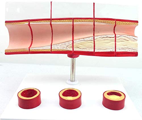 LBYLYH Trombosis Modelo De Proceso - Equipos Médicos CHD -PVC Corazón Humano Modelo Anatómico Modelo De Educación Médica para La Educación Médica